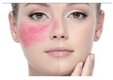 ROSACEA 1
