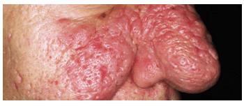 ROSACEA 3
