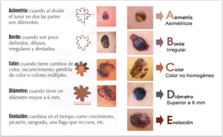 abcde-detectar-cancer-de-piel-ceen