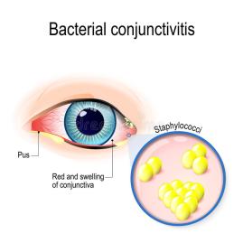 bacterial-conjunctivitis-eye-bacteria-cause-staphylococci-92536911