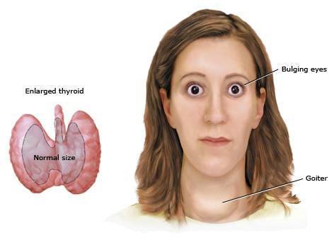 overactive_thyroid_pi