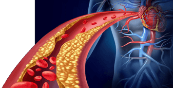 trigliceridos-altos-hipertrigliceridemia