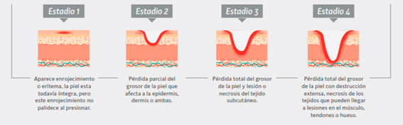 estadios-escaras-ulceras-por-presion