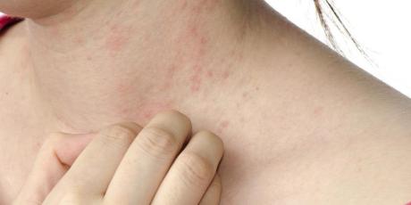 dermatitis-contacto