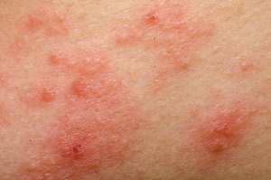 eczema atopic dermatitis symptom skin texture