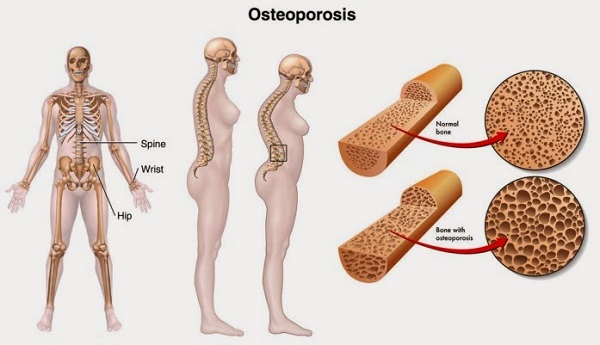 osteoporosis