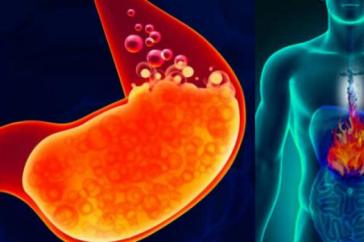 causas-sintomas-de-la-acidez-estomacal2017