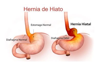 hernia-de-hiato-ardores-digestivo-sevilla
