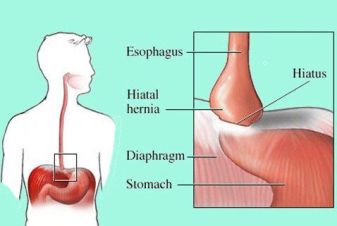 hiatalhernia2_thumb