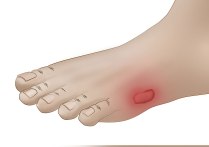 2-rozaduras-y-heridas