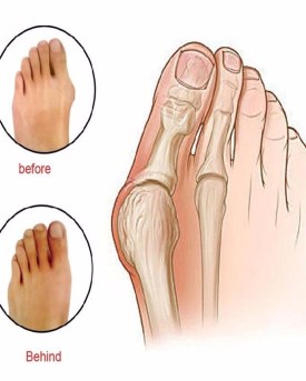 corrector-protector-de-juanetes-d_nq_np_759505-mlm25041316658_092016-f