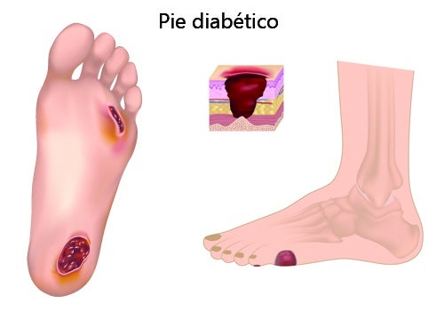 pie-diabetico-500x350-1