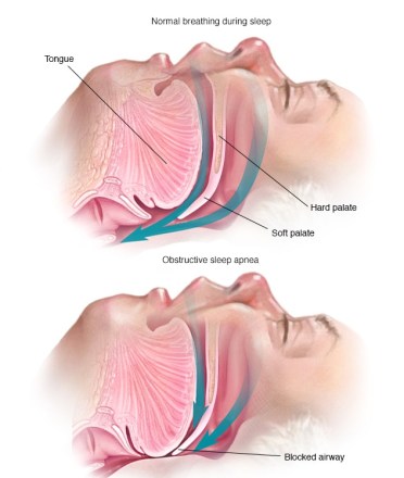 sl7_sleep_apnea-8col