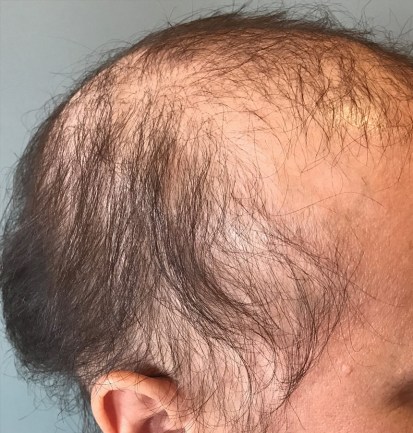 alopecia-y-qt-1