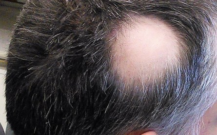 alopecia_areata_1