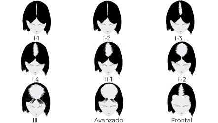 escala-savin-alopecia-femenino