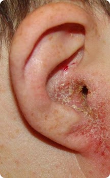 otitis2bexterna2beccematosa