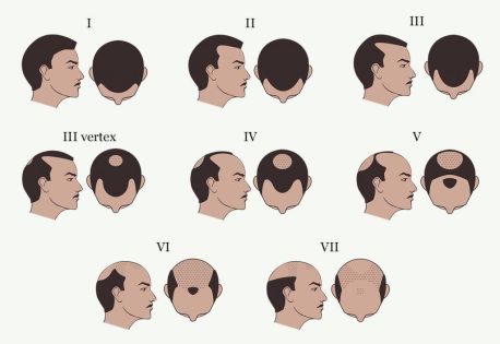 post-escala-norwood-hamilton2-1024x705-1