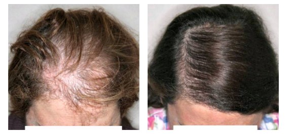 xantes-despues-ludwig-700x330.jpg.pagespeed.ic_.lnjgv3gyan