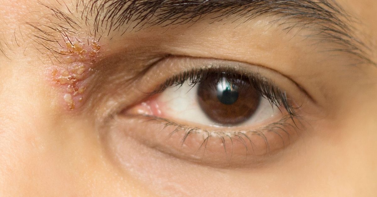 herpes-oculares_virus-del-herpes-simple_vhs_clc3adnica-visioncore