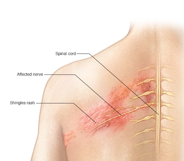 sn7_shinglescauses-8col